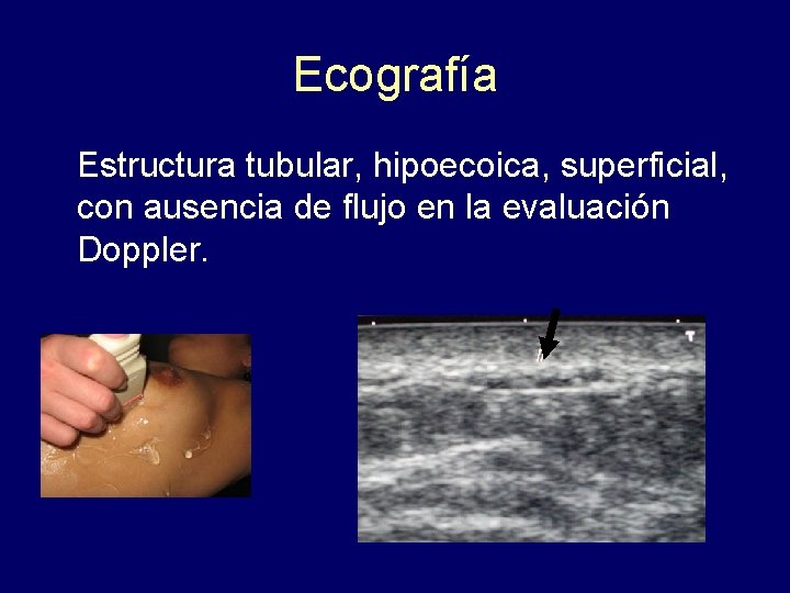 Ecografía Estructura tubular, hipoecoica, superficial, con ausencia de flujo en la evaluación Doppler. 