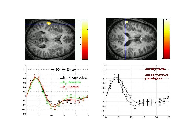 18 Auditif primaire Aire du traitement phonologique UNAF-SHFJ J. B. Poline Ciuciu et al,