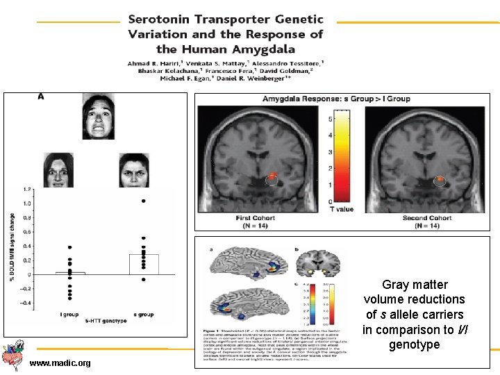 Gray matter volume reductions of s allele carriers in comparison to l/l genotype www.