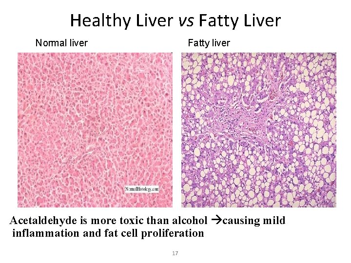 Healthy Liver vs Fatty Liver Normal liver Fatty liver Acetaldehyde is more toxic than