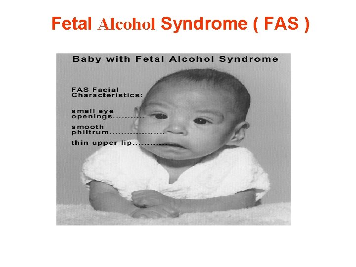 Fetal Alcohol Syndrome ( FAS ) 