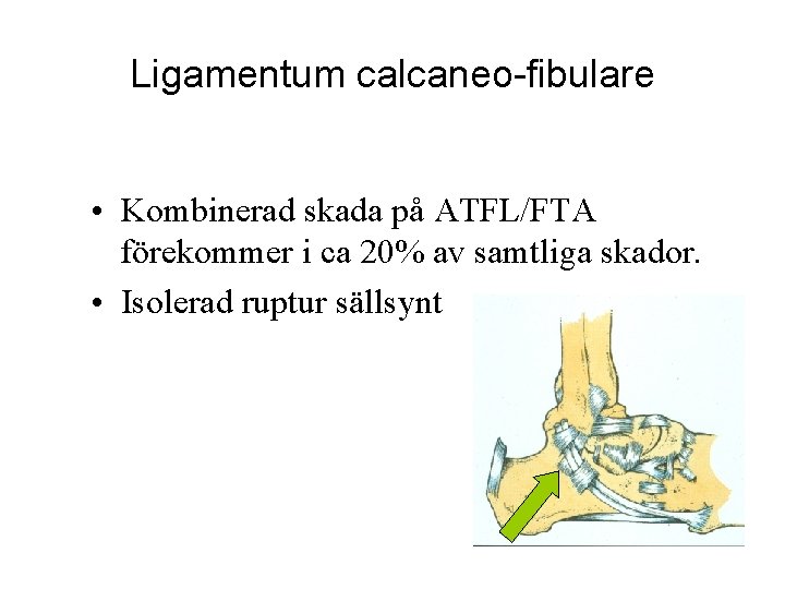 Ligamentum calcaneo-fibulare • Kombinerad skada på ATFL/FTA förekommer i ca 20% av samtliga skador.