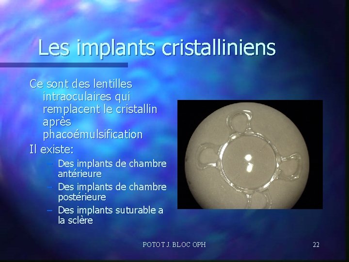 Les implants cristalliniens Ce sont des lentilles intraoculaires qui remplacent le cristallin après phacoémulsification