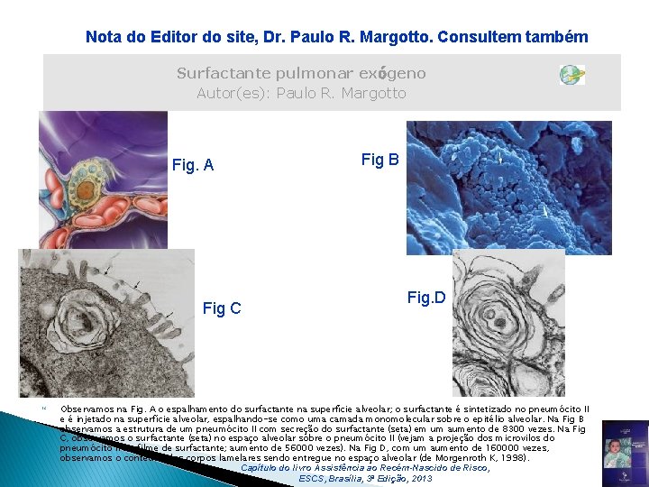 Nota do Editor do site, Dr. Paulo R. Margotto. Consultem também Surfactante pulmonar exógeno