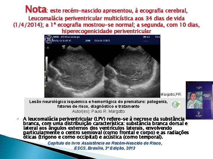 Nota: este recém-nascido apresentou, à ecografia cerebral, Leucomalácia periventricular multicística aos 34 dias de