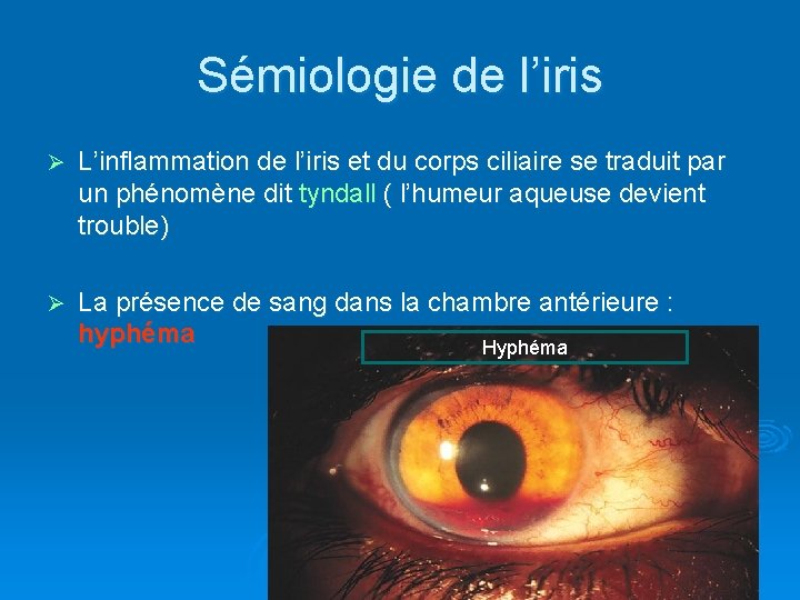Sémiologie de l’iris Ø L’inflammation de l’iris et du corps ciliaire se traduit par