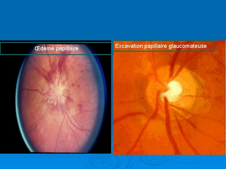 Œdème papillaire Excavation papillaire glaucomateuse 