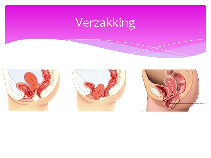 Verzakking 