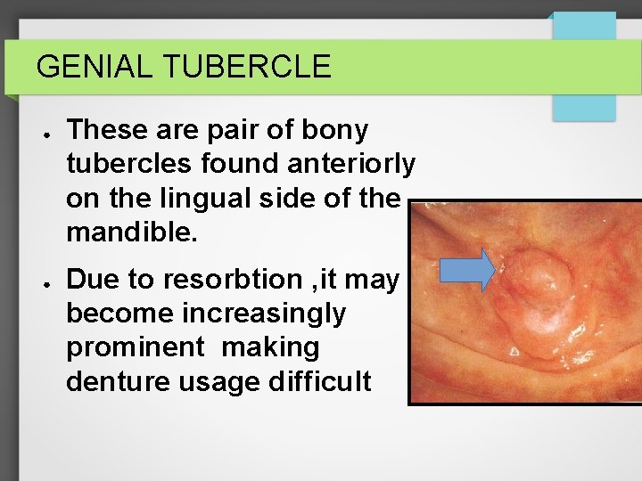 GENIAL TUBERCLE ● ● These are pair of bony tubercles found anteriorly on the