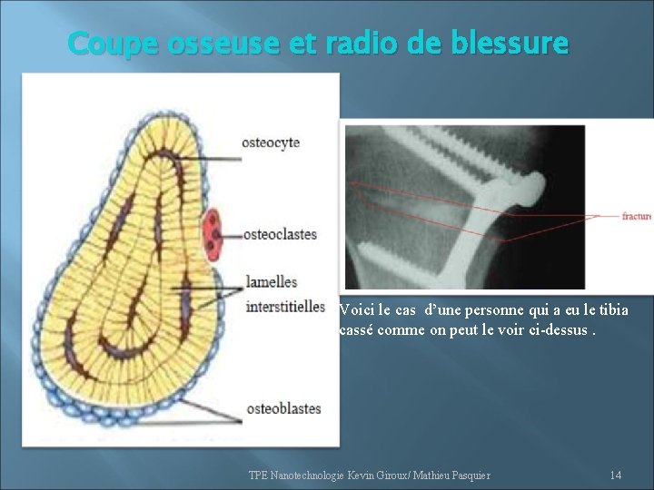 Coupe osseuse et radio de blessure Voici le cas d’une personne qui a eu