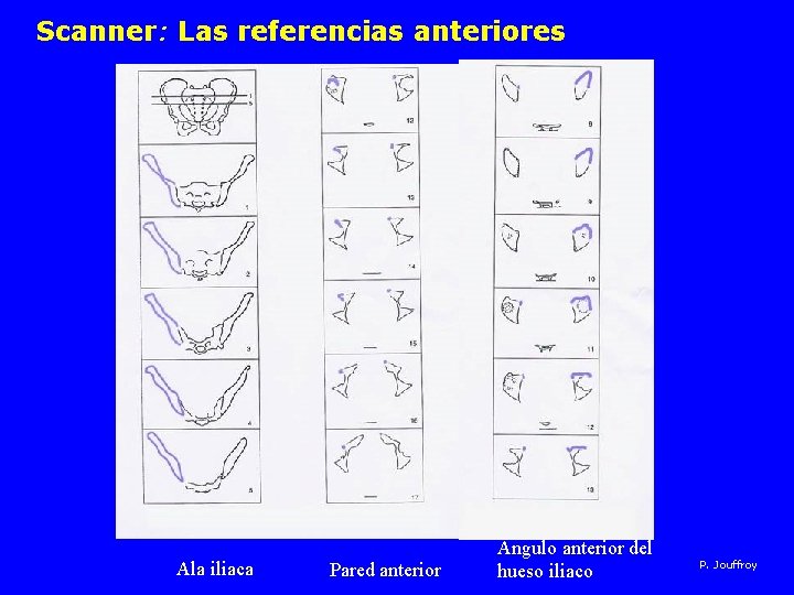Scanner: Las referencias anteriores Ala iliaca Pared anterior Angulo anterior del hueso iliaco P.