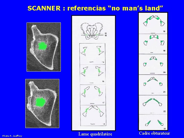 SCANNER : referencias “no man’s land” Photo P. Jouffroy Techo Lame quadrilatère Cadre obturateur