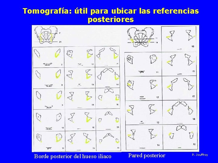 Tomografía: útil para ubicar las referencias posteriores Borde posterior del hueso iliaco Pared posterior