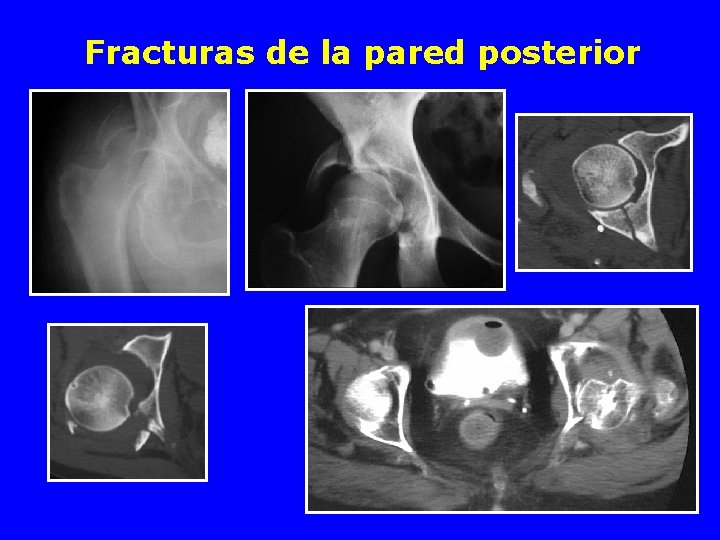 Fracturas de la pared posterior 