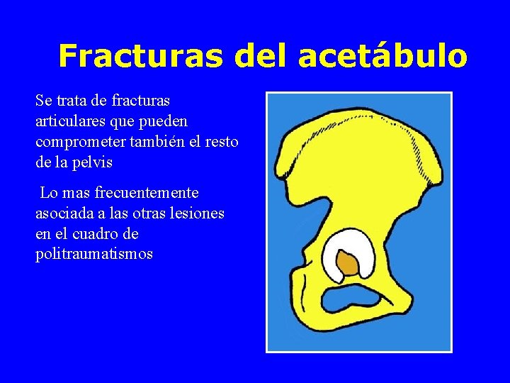 Fracturas del acetábulo Se trata de fracturas articulares que pueden comprometer también el resto