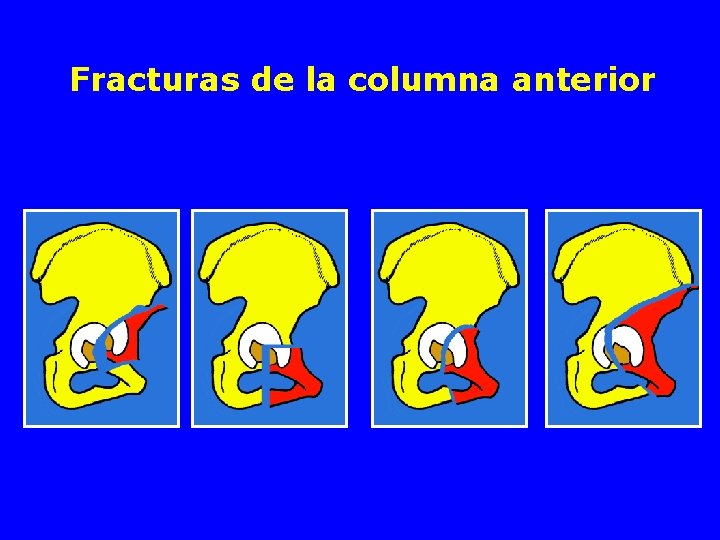 Fracturas de la columna anterior 