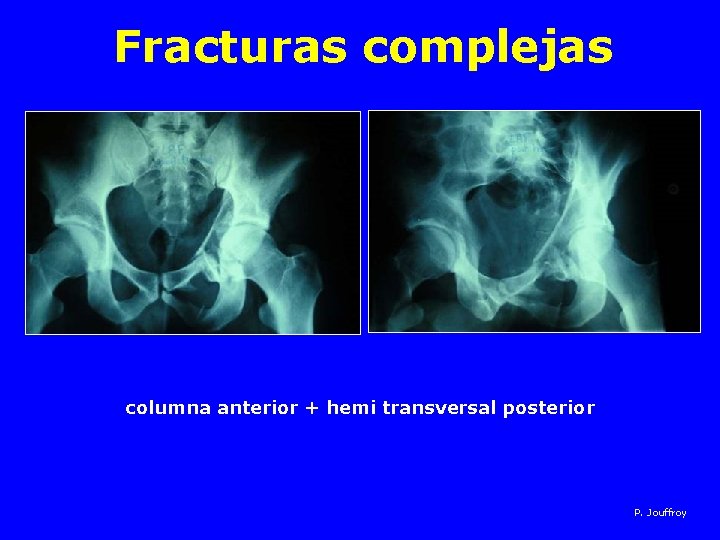 Fracturas complejas columna anterior + hemi transversal posterior P. Jouffroy 