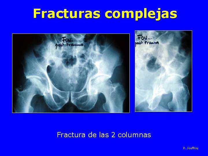 Fracturas complejas Fractura de las 2 columnas P. Jouffroy 