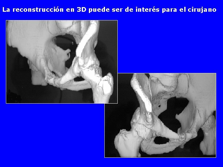 La reconstrucción en 3 D puede ser de interés para el cirujano 