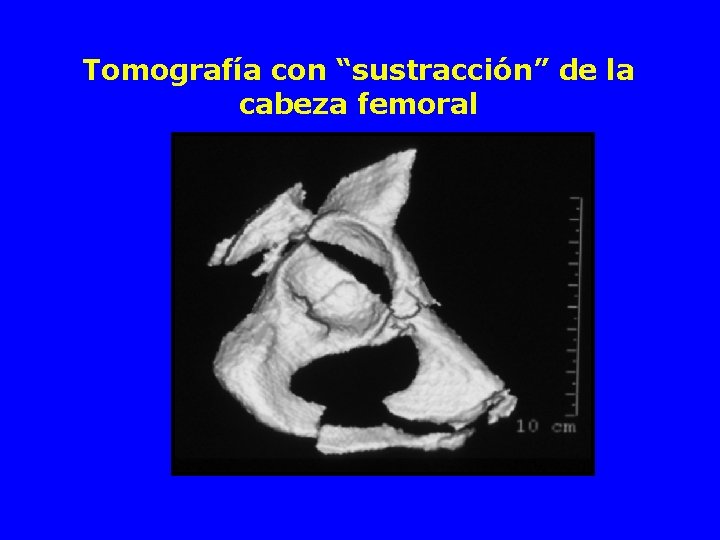 Tomografía con “sustracción” de la cabeza femoral 