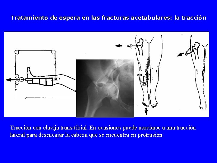 Tratamiento de espera en las fracturas acetabulares: la tracción Tracción con clavija trans-tibial. En