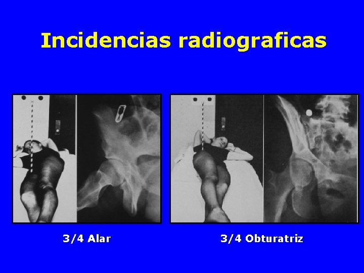 Incidencias radiograficas 3/4 Alar 3/4 Obturatriz 