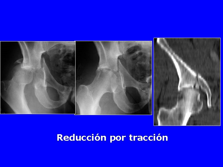 Reducción por tracción 