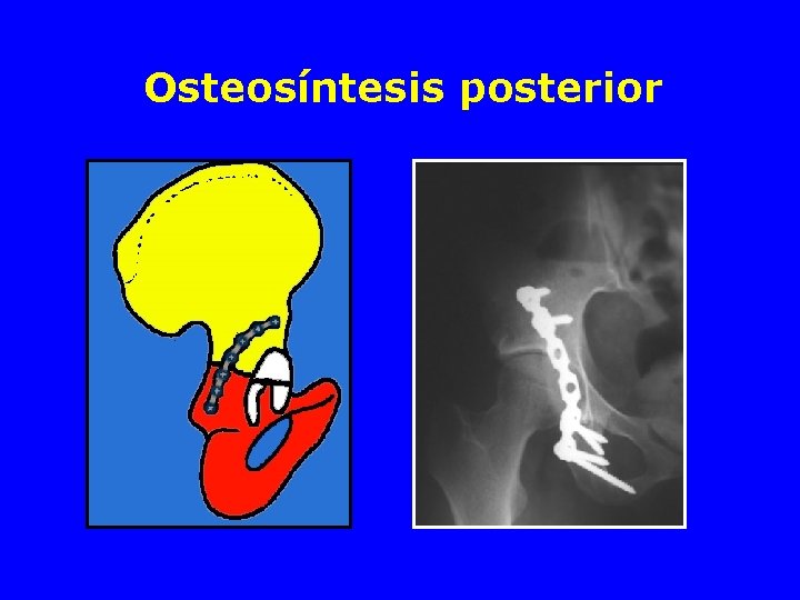 Osteosíntesis posterior 