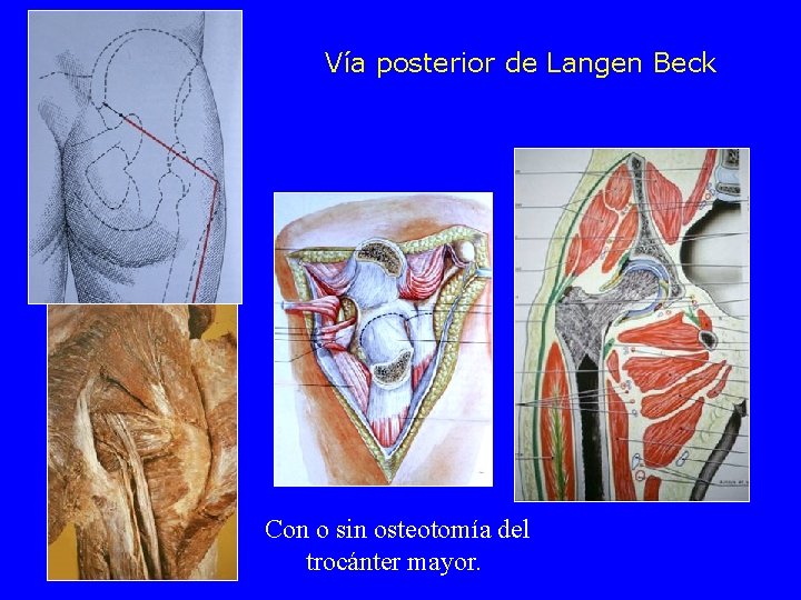 Vía posterior de Langen Beck Con o sin osteotomía del trocánter mayor. 