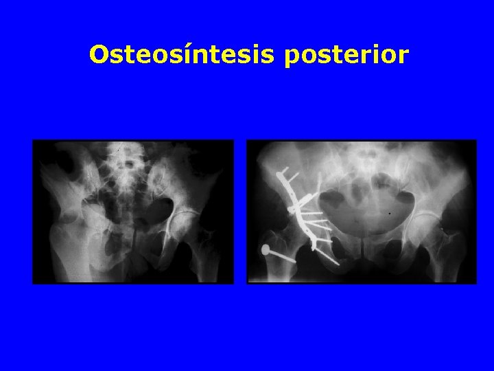 Osteosíntesis posterior 