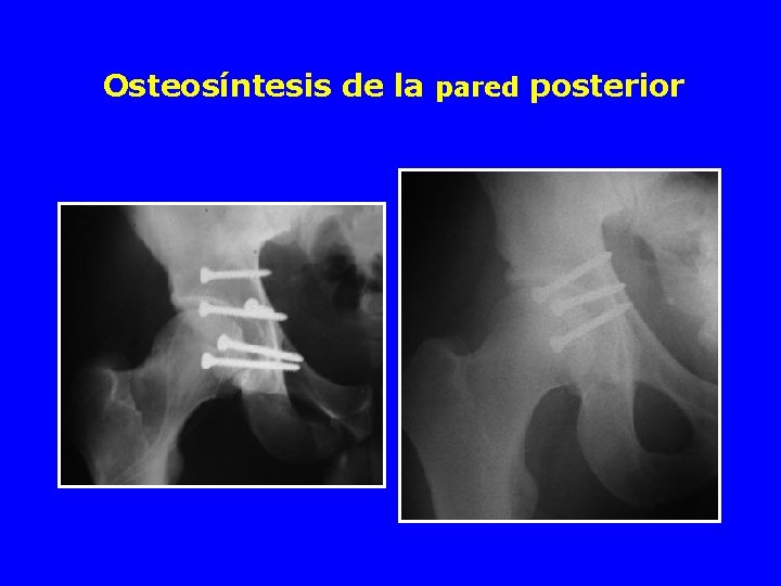 Osteosíntesis de la pared posterior 