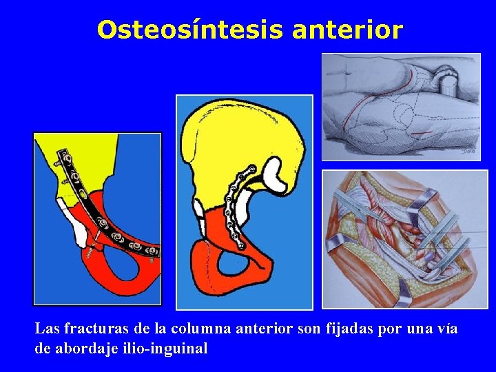 Osteosíntesis anterior Las fracturas de la columna anterior son fijadas por una vía de