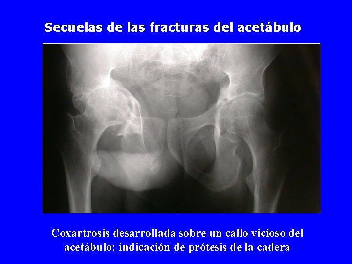 Secuelas de las fracturas del acetábulo Coxartrosis desarrollada sobre un callo vicioso del acetábulo: