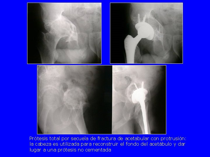 Prótesis total por secuela de fractura de acetabular con protrusión: la cabeza es utilizada