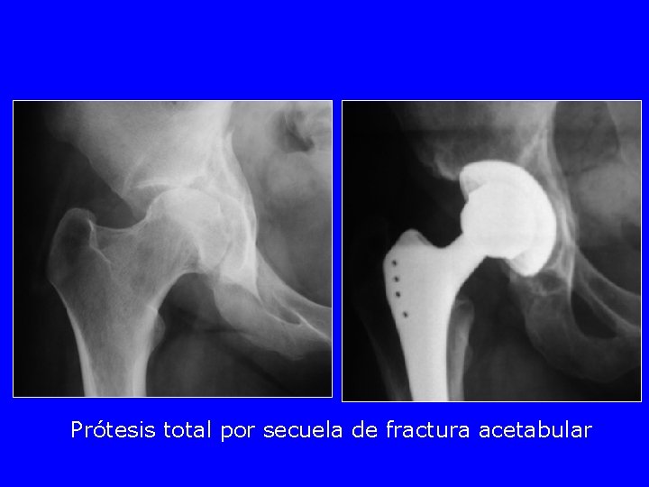 Prótesis total por secuela de fractura acetabular 