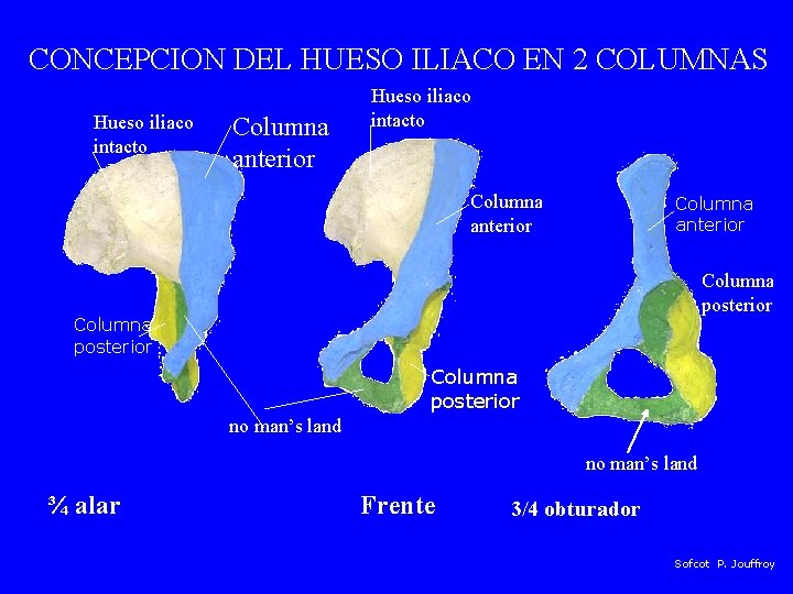 CONCEPCION DEL HUESO ILIACO EN 2 COLUMNAS Hueso iliaco intacto Columna anterior Columna posterior