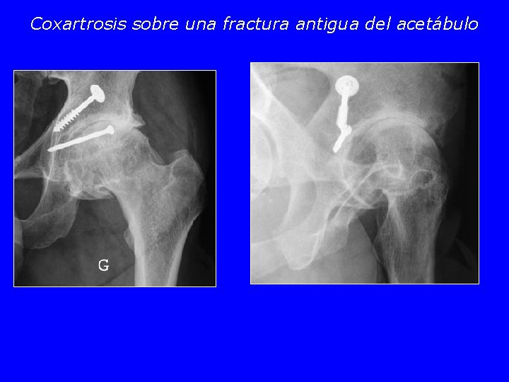 Coxartrosis sobre una fractura antigua del acetábulo 