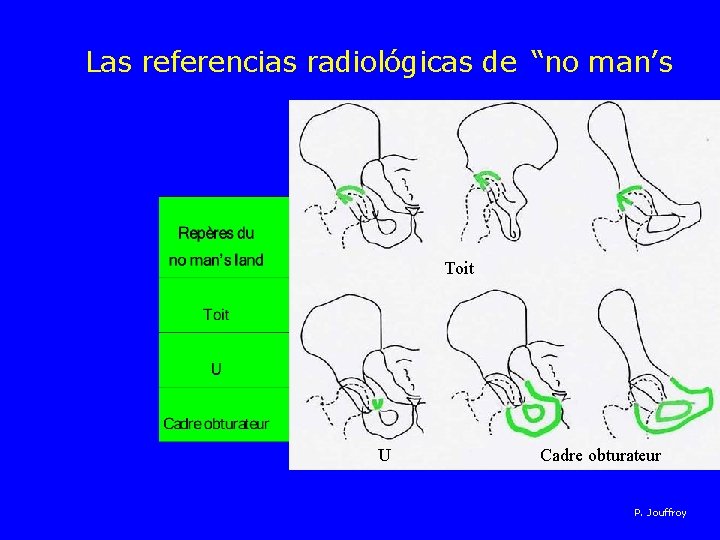 Las referencias radiológicas de “no man’s Toit U Cadre obturateur P. Jouffroy 