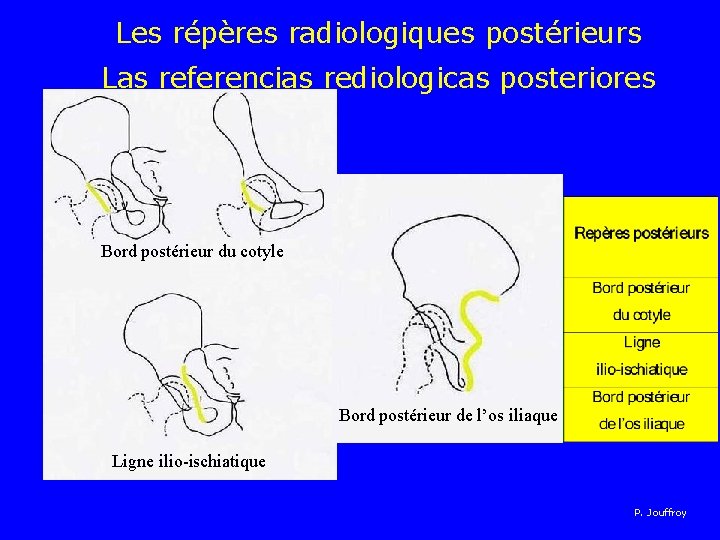Les répères radiologiques postérieurs Las referencias rediologicas posteriores Bord postérieur du cotyle Bord postérieur