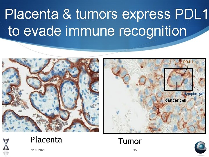 Placenta & tumors express PDL 1 to evade immune recognition PD-L 1 lymphocyte cancer