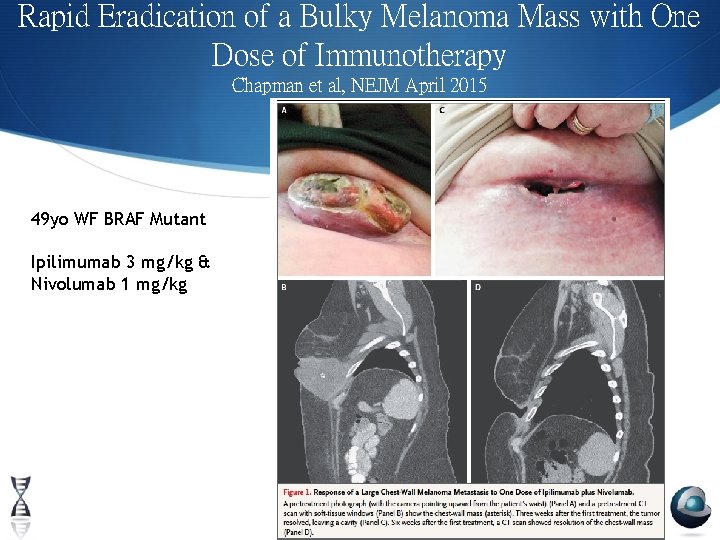 Rapid Eradication of a Bulky Melanoma Mass with One Dose of Immunotherapy Chapman et