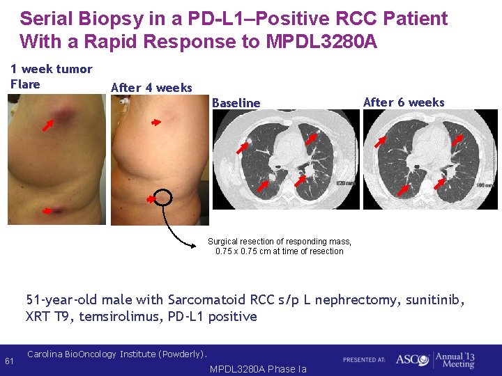 Serial Biopsy in a PD-L 1–Positive RCC Patient With a Rapid Response to MPDL