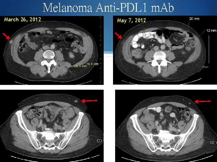Melanoma Anti-PDL 1 m. Ab March 26, 2012 May 7, 2012 