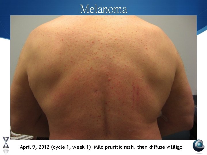 Melanoma April 9, 2012 (cycle 1, week 1) Mild pruritic rash, then diffuse vitiligo