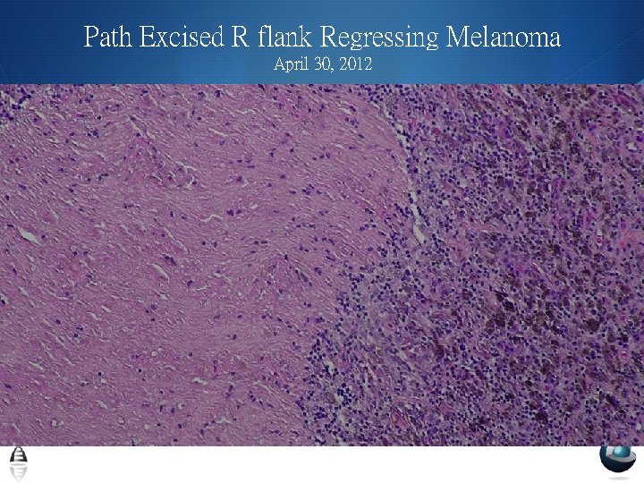 Path Excised R flank Regressing Melanoma April 30, 2012 