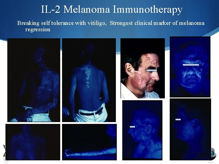 IL-2 Melanoma Immunotherapy Breaking self tolerance with vitiligo, Strongest clinical marker of melanoma regression