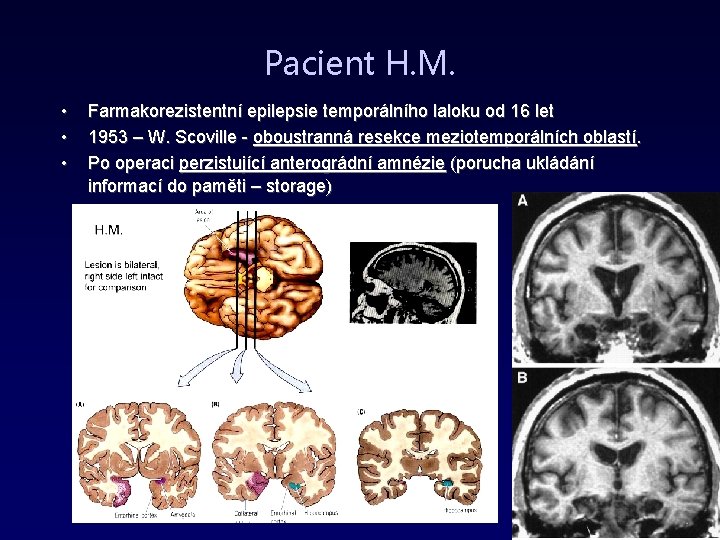 Pacient H. M. • • • Farmakorezistentní epilepsie temporálního laloku od 16 let 1953