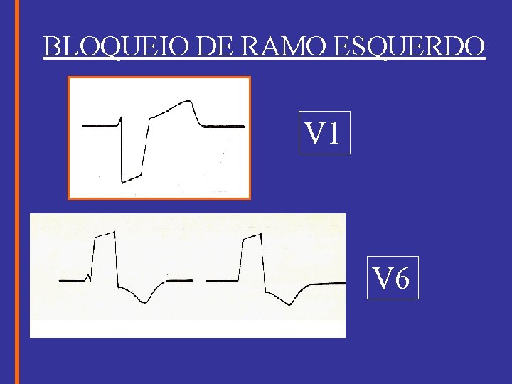 BLOQUEIO DE RAMO ESQUERDO V 1 V 6 