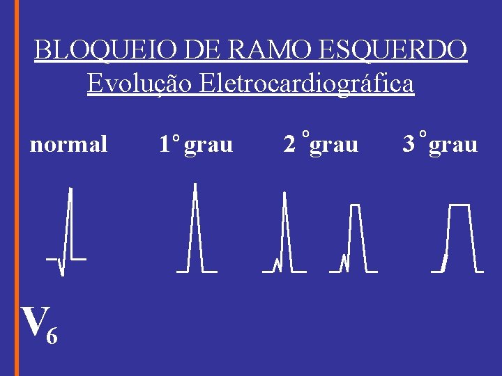 BLOQUEIO DE RAMO ESQUERDO Evolução Eletrocardiográfica normal V 6 1 grau O O 2