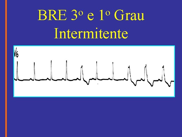 o 3 o 1 BRE e Grau Intermitente 